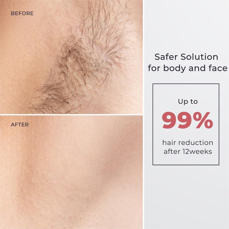 At-Home IPL Hair Removal Device for Men and Women with Ice-Cooling