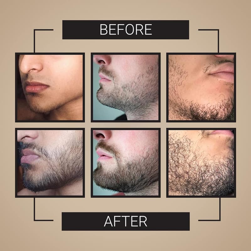 Beard Growth Kit - 3-Month Complete Set with Oils & Roller